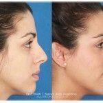 Fotos antes y después de una rinoplastía