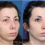 Nariz de aspecto “operada” (surgical look)