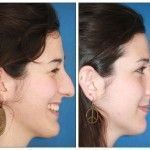 Mi Testimonio de Rinoplastia