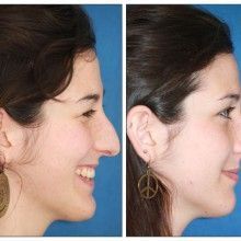 Mi Testimonio de Rinoplastia