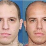 Rinoplastía en Hombres
