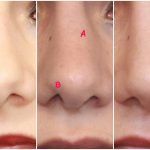 Retoque de imperfecciones en Rinoplastia