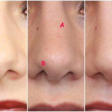 Retoque de imperfecciones en Rinoplastia